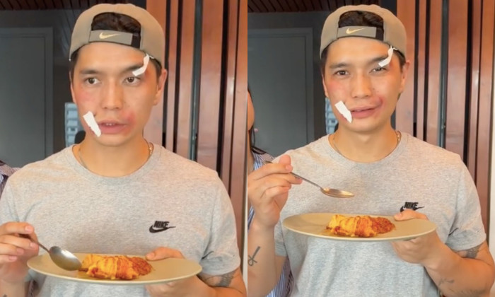 Huy Trần xuất hiện với vết bầm tím trên mặt.