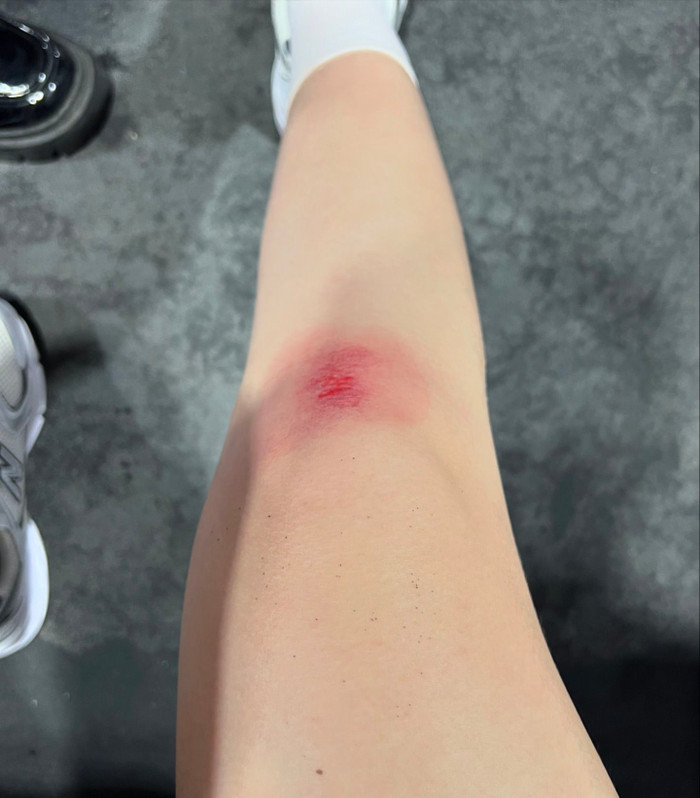 Nhiều người hâm mộ lo lắng khi chứng kiến Đỗ Thị Hà bị thương vì chơi pickleball. Ảnh: Instagram doha.hhvn