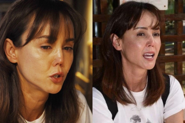 Chiếc mũi của nữ diễn viên bị biến dạng sau khi cô ngã trong nhà tắm. 