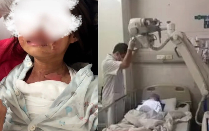 Bé gái 6 tuổi bỏng nặng vì bạn tạt nước sôi, trường học nói chỉ là trò đùa và cái kết Ảnh 2