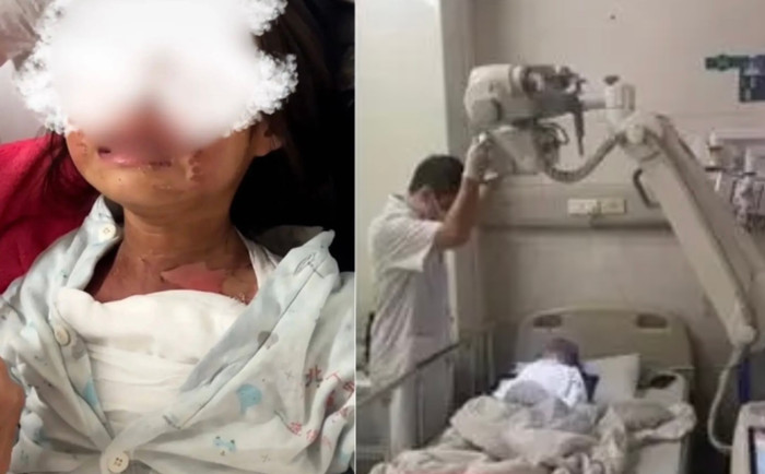 Bé gái 6 tuổi bị bạn hắt nước sôi, bố mẹ phẫn nộ khi nhà trường bao che.