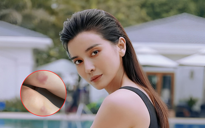 Cao Thái Hà bị thương tích đầy mình Ảnh 2