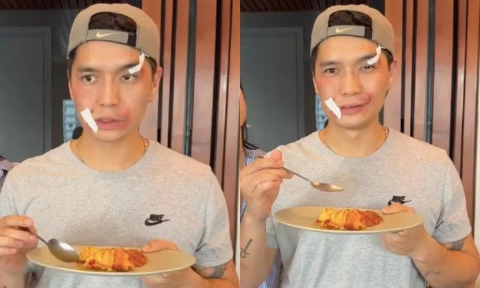 Chồng Ngô Thanh Vân xuất hiện với gương mặt bầm tím. 