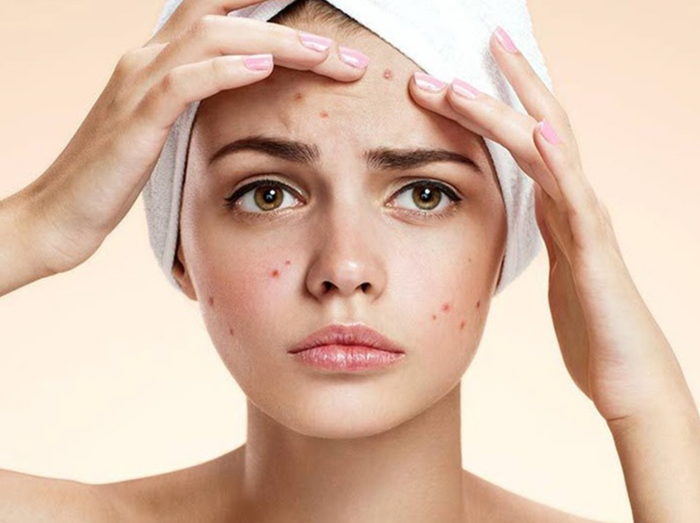 Công dụng nổi bật nhất của tinh dầu tràm trà chính là việc điều trị mụn.