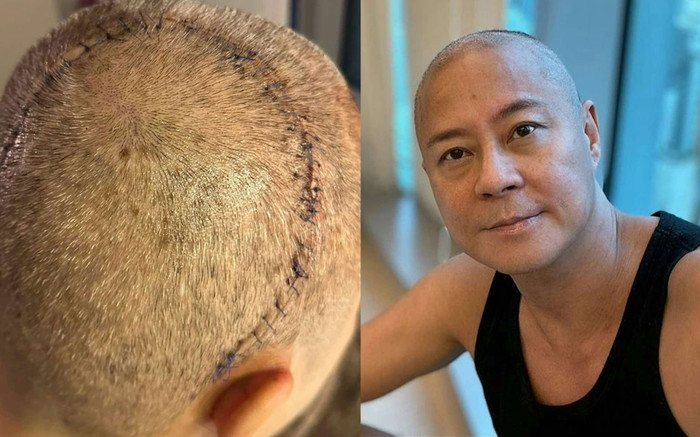 Nam ca sĩ nổi tiếng đăng ảnh phẫu thuật khối u não, tình trạng khiến nhiều người bàng hoàng Ảnh 2