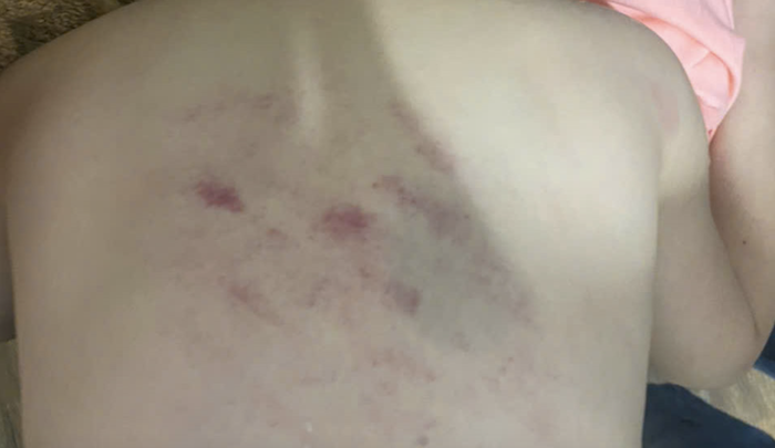 Vết thương của một em học sinh bị cô T. đánh. 