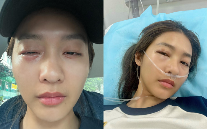 Showbiz 24h: Khả Ngân khiến nhiều khán giả xót xa vì hình ảnh khuôn mặt bị sưng vù. Ảnh: Thread imkhangan