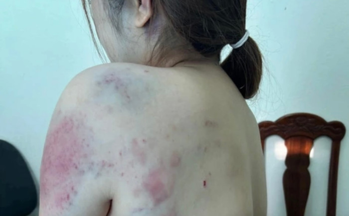 Người phụ nữ bị chồng sắp cưới nhốt, bạo hành liên tục 13 tiếng, trên người đầy vết bầm tím Ảnh 1