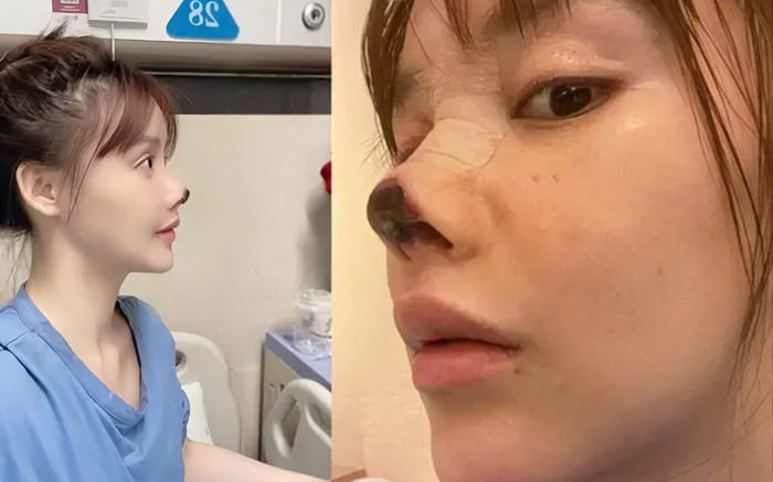 Nữ diễn viên bị rụng mũi sau khi phẫu thuật thẩm mỹ Ảnh 2