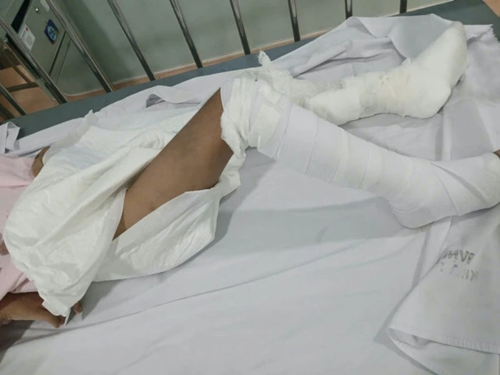 Cháu bé 6 tuổi đang được điều trị tại bệnh viện. Ảnh: SGGP