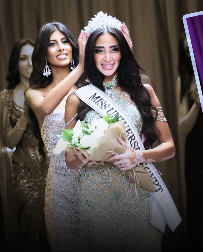 Tân Hoa hậu Hoàn vũ Ai Cập là một người mẫu bạch biến.