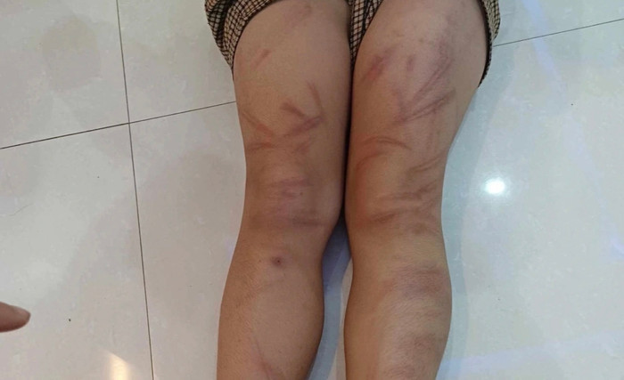 Hình ảnh trẻ mầm non bị đánh được chia sẻ trên mạng xã hội.