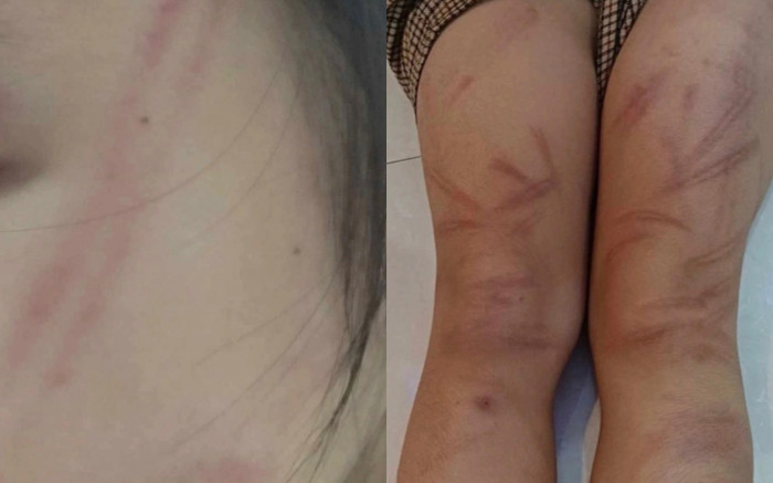 Nhiều trẻ mầm non bị đánh bầm tím cơ thể, công an vào cuộc xác minh Ảnh 2
