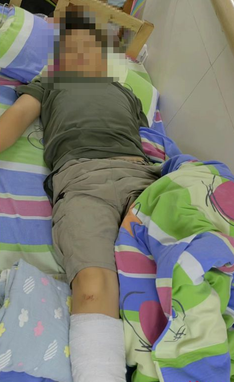 Cậu bé Tiểu Trần bị gãy xương chân khi tham gia trại hè.