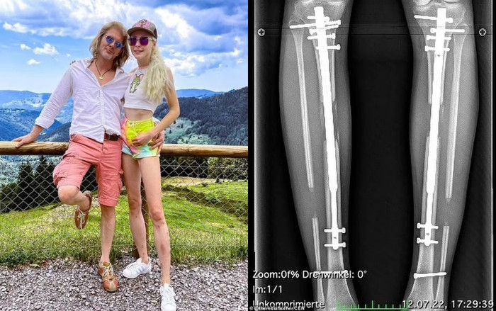 Người chồng chia tay sau khi nữ người mẫu thực hiện phẫu thuật kéo dài chân.