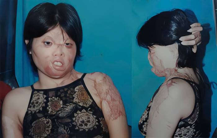 Khuôn mặt cô biến dạng vì bị chồng cũ tạt axit.