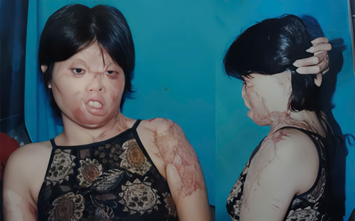 Nữ diễn viên phẫu thuật gần 50 lần vì bị chồng cũ tạt axit Ảnh 2