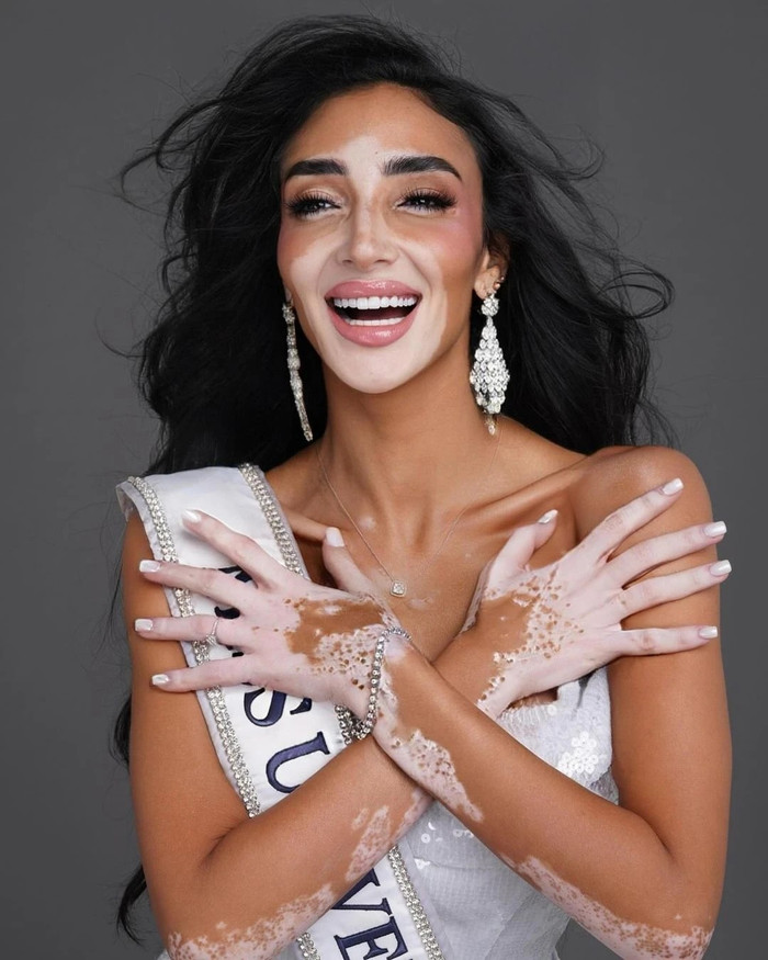 Logina Salah - đại diện đến từ Ai Cập năm nay 33 tuổi và là mẹ đơn thân. Người đẹp này là chuyên gia trang điểm và có một thương hiệu làm đẹp riêng. Từ bé, cô bị chấn đoán bị bệnh bạch biến. Con gái của cô đã 10 tuổi. Hai mẹ con chuyển tới Dubai sống cách đây 3 năm trước. Rất có thể, đây là một màu sắc cá tính khác lạ sẽ được chọn vào Top 30.