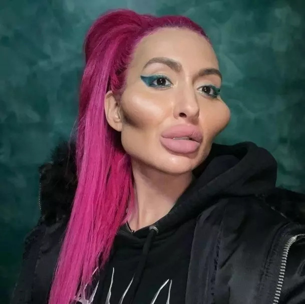 Nữ người mẫu Anastasia Pokreshchuk nổi tiếng với biệt danh 'người có đôi má lớn nhất thế giới.