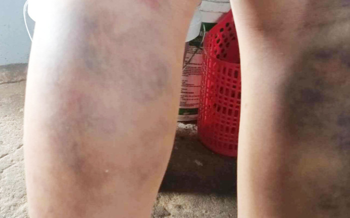 Đình chỉ cô giáo ở Quảng Nam đánh học sinh bầm tím hai chân Ảnh 2