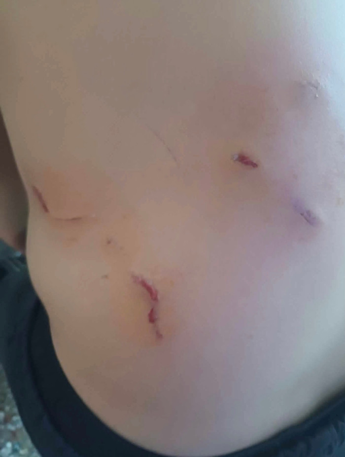 Người đàn ông có nhiều thương tích sau khi bị voọc tấn công.