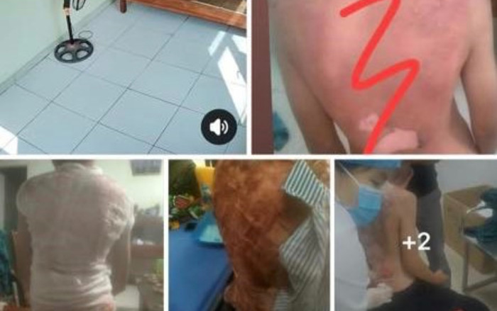 Công an vào cuộc điều tra vụ bé trai bị bỏng nặng do mẹ kế dội nước sôi Ảnh 2