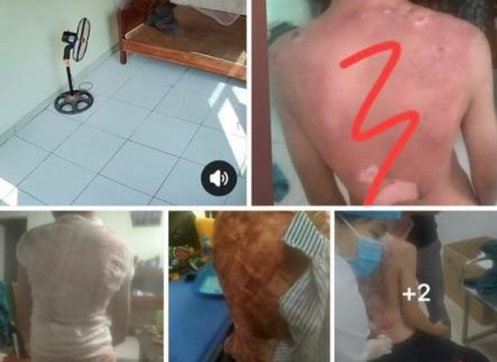 Bé trai bỏng nặng nghi do mẹ kế bạo hành, công an tỉnh Vĩnh Phúc đã vào cuộc điều tra - Ảnh: Mạng xã hội