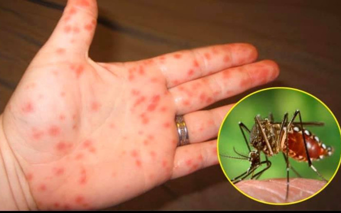 Cảnh giác với cao điểm dịch sốt xuất huyết: Cần biết các biện pháp phòng tránh gì? Ảnh 2