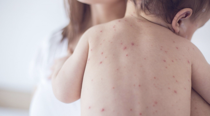 Với trẻ nhỏ nên dùng tã trẻ em xua muỗi và khăn lau xua muỗi để bảo vệ trẻ khỏi bị muỗi đốt gây bệnh sốt xuất huyết.