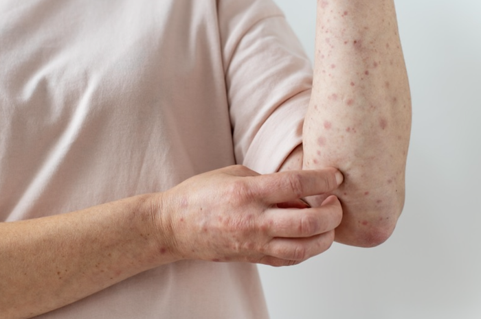 Mưa lớn kéo dài là nguyên nhân khiến diễn tiến dịch sốt xuất huyết trở nên phức tạp.