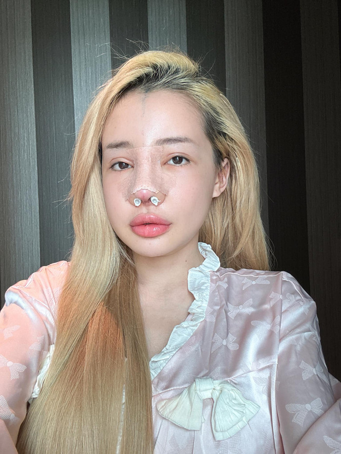 Cư dân mạng bàn luận về chiếc mũi sửa của Ngân 98.