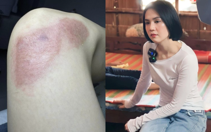 Vết sẹo của Ngọc Trinh do tai nạn xe mô tô hồi tháng 10/2023 mờ dần sau nhiều lần điều trị. (Ảnh: FBNV)