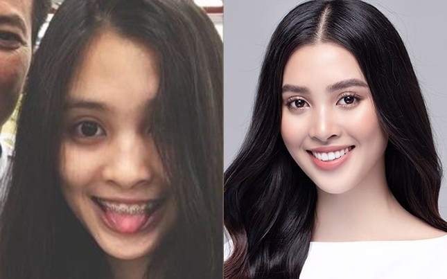 Tiểu Vy sở hữu gương mặt 'tỷ lệ vàng' sau khi niềng răng. (Ảnh FBNV)