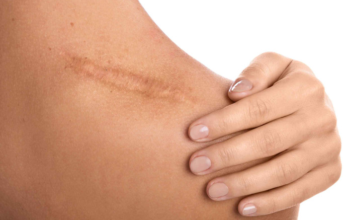 3 cách trị sẹo lồi không cần tiêm chích hay đi laser Ảnh 2