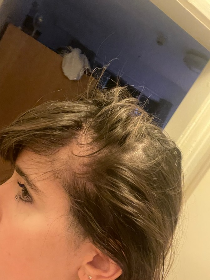 Sofia đã đi khám bác sĩ da liễu và được chẩn đoán mắc chứng rụng tóc do nội tiết tố androgen. 