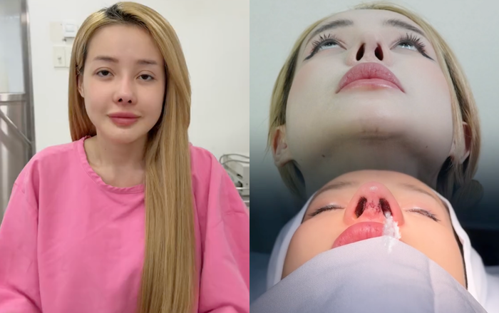 Bác sĩ H., cho biết, Ngân 98 đang bị viêm ở trụ mũi nên cần thêm thời gian để điều trị (Ảnh: Chụp màn hình TikTok bác sĩ H.,)