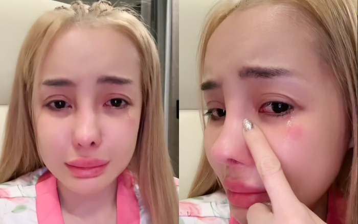 Hình ảnh gương mặt sưng vù của Ngân 98 trước khi sang Mỹ biểu diễn. (Ảnh: FBNV)