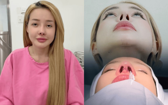 Ngân 98 sửa mũi lần thứ 10. (Ảnh: Chụp màn hình TikTok bác sĩ H.)