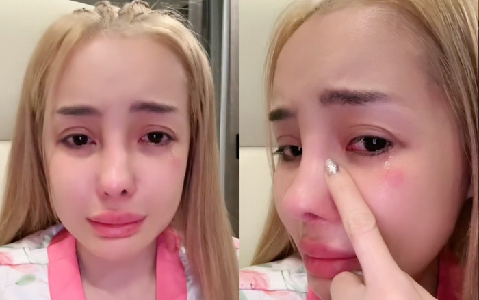 Ngân 98 lộ mũi sưng vù sau khi ăn hải sản. (Ảnh FBNV)