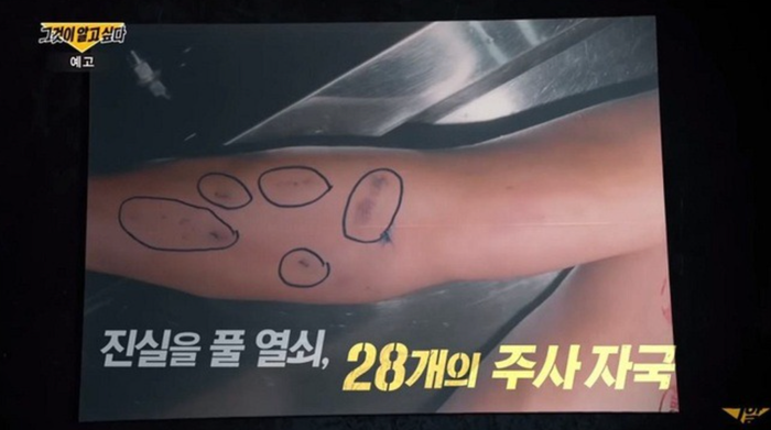 Nhiều dấu kim trên cánh tay phải của nam ca sĩ Kim Sung Jae được phát hiện trong qua trình khám nghiệm tử thi. (Ảnh: Sưu tầm)