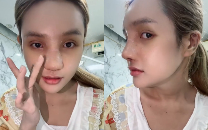 Chiếc mũi của em gái Ngân 98 vẫn còn trong tình trạng sưng tấy.