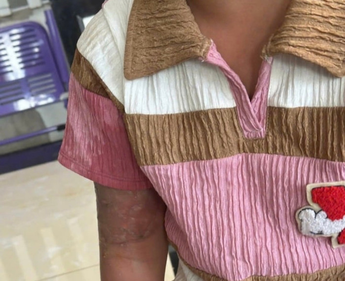 Bé gái bị bà Phượng tạt nước sôi vào người.