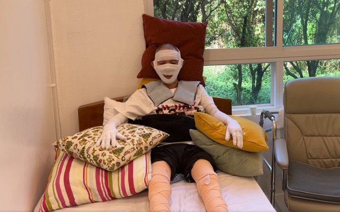 Xót xa nam ca sĩ nổi tiếng một thời bị bệnh nặng hơn 5 năm, băng bó khắp người để điều trị Ảnh 2