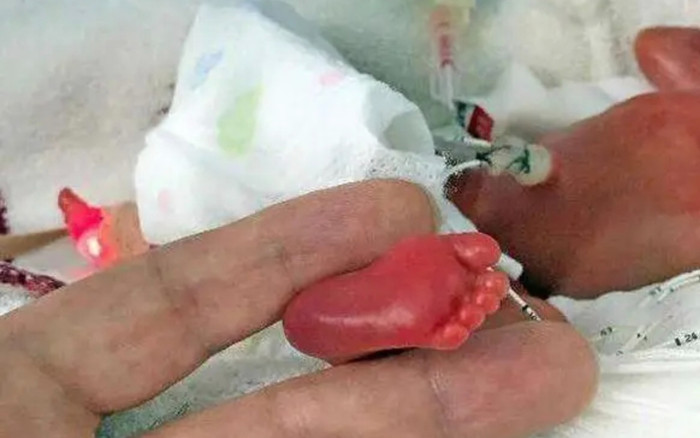 Em bé sinh non nhẹ nhất thế giới, nặng 280g, bé như 'hạt đậu' từng gây chấn động giờ ra sao? Ảnh 2