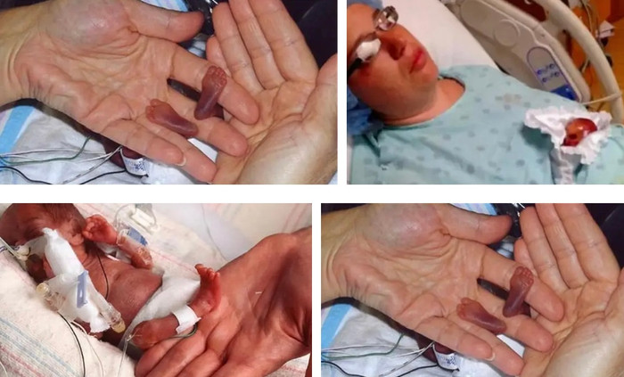 Bệnh viện Nhi Miami đã thực hiện ca mổ lấy thai cho mẹ của Amelia vào ngày 24/10/2006.