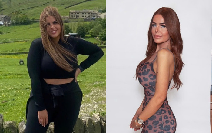 Lucy trước và sau khi thu nhỏ dạ dày với giá rẻ. 