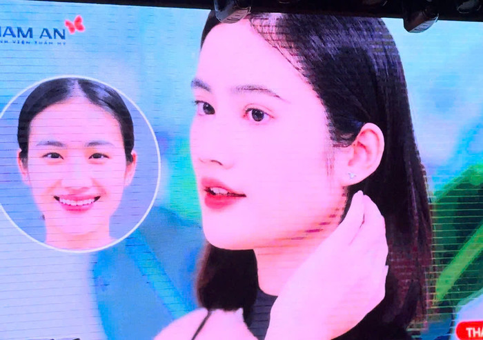 Hình ảnh thay đổi trước và sau của Hoa hậu Ý Nhi sau khi phẫu thuật thẩm mỹ. 