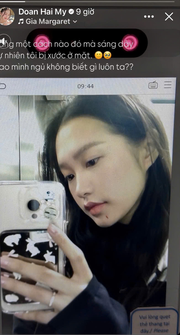 Vợ Đoàn Văn Hậu chia sẻ vết thương trên mặt Ảnh 1