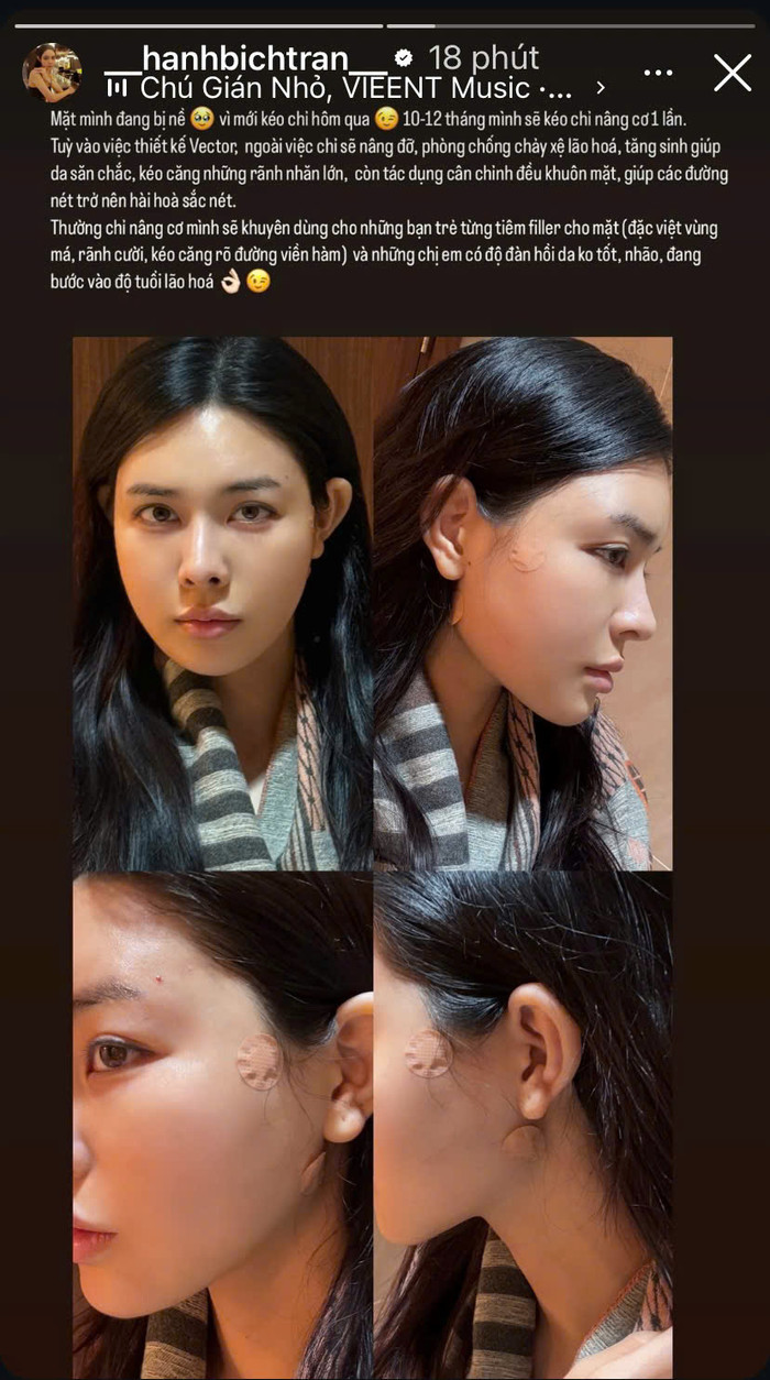 Bạn gái Vũ Văn Thanh công khai chuyện thẩm mỹ. 