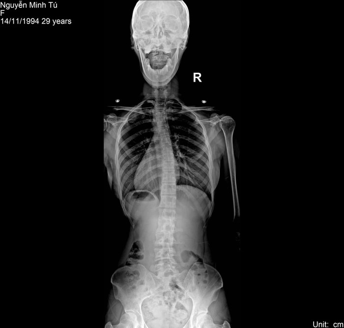 Không chỉ chuyện con cái, Minh Tú còn có thể bị ảnh hưởng về chuyện đi lại.